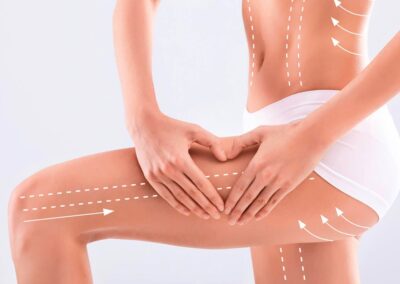 Fettabsaugung (Liposuktion)