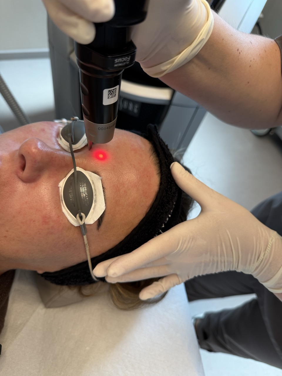 Fraktionierte CO2-Laserbehandlung in Potsdam – schonende Hautstraffung bei Dr. Jasmin Last in Werder