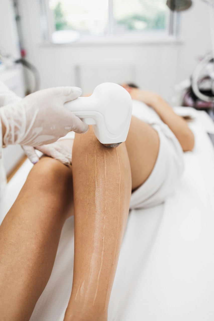 Laser Haarentfernung Potsdam – dauerhafte Haarentfernung mit medizinischer Präzision und modernem Lasergerät bei Dr. Jasmin Last