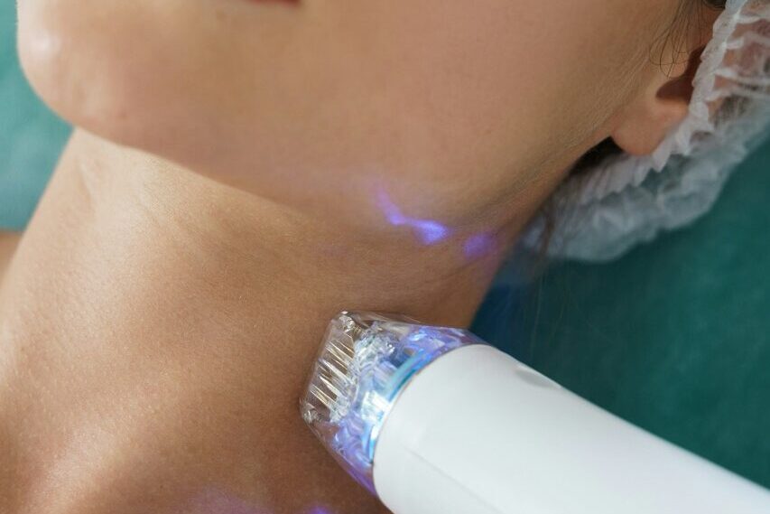 Radiofrequenz-Microneedling zur Hautverjüngung in Potsdam – sanfte Behandlung bei Dr. Jasmin Last