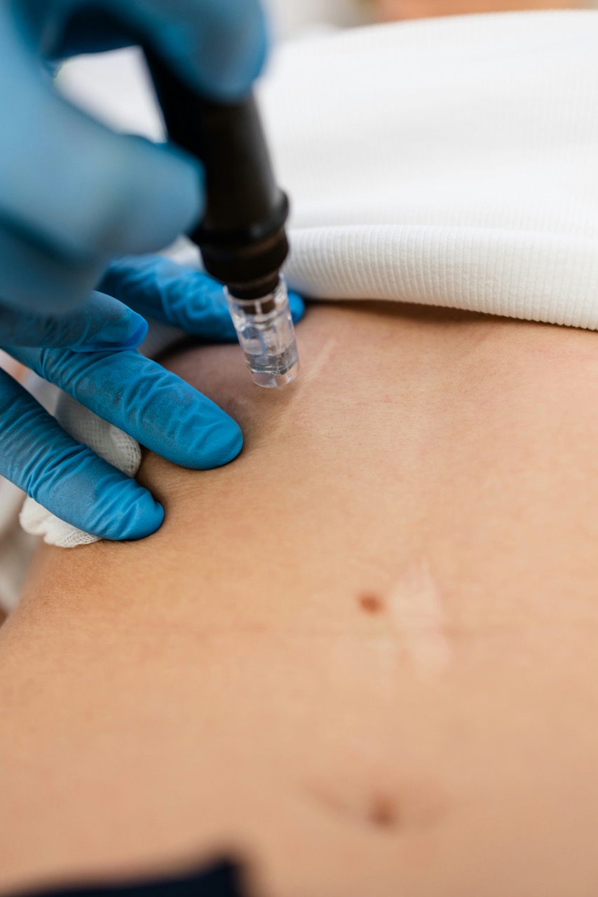 Laserbehandlung gegen Narben Potsdam – moderne Hauttherapie für Männer zur Glättung und Verfeinerung des Hautbildes bei Dr. Jasmin Last